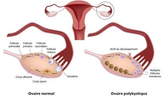 Mon histoire de conception avec le syndrome des ovaires polykystiques (SOPK)